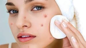 Làm gì khi uống L-cystine bị nổi mụn? Hướng dẫn sử dụng