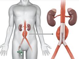 Anteriormente, esse diagnóstico e suas complicações quase sempre levavam à morte do paciente. Quais Os Sintomas Da Aneurisma Da Aorta Abdominal