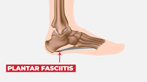 The foot is a complicated anatomical structure that carries the weight of the body, and pain can manifest in different ways depending on the cause. 29 Quick Solutions That Every Runner With Foot Pain Need To Know