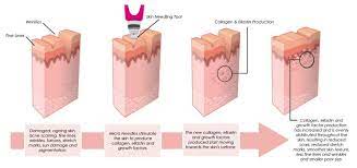 Collagen Induction Therapy Infomation Goodwood House Of Beauty