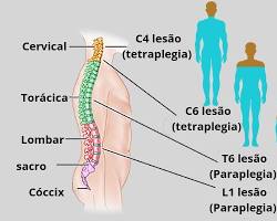 Imagem de Lesão na coluna vertebral