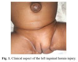 Image result for Inguinal hernia child