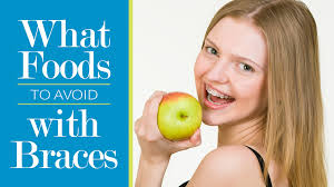 What foods to avoid with braces. What Foods To Avoid With Braces Midwest Orthodontics Center Blog