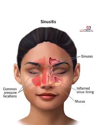 Hi All, I have a 14 year old son who suffers with sinus at times. When he  does I use nasal rinses and steroid nasal spray etc etc… to clear it but