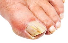 If you suspect that such a problem has. What Causes Toenail Fungus How To Prevent Onychomycosis Or Crusty Yellow Nails Men S Health