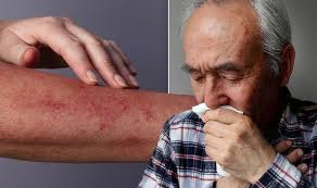 Whatever you need, whatever you want, whatever you desire, we provide. Coronavirus Symptoms Signs Of Covid 19 Infection Include Rash On Your Skin Express Co Uk