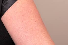 A rash can be caused by an allergic reaction to something in your environment, from grass to pet dander. Red Bumps On Upper Arms Pictures Photos