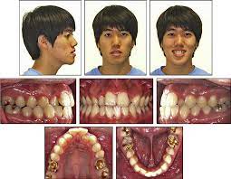 Pdf Microimplant Assisted Rapid Palatal Expansion Appliance To Orthopedically Correct Transverse Maxillary Deficiency In An Adult Semantic Scholar