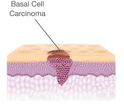 Here we look at some of the key symptoms of this disease to watch out for. Types Of Skin Cancer National Council On Skin Cancer Prevention