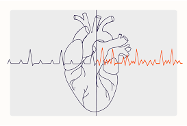 Image result for Atrial Fibrillation