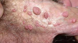 HPV em Homens - Sou Enfermagem