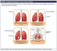 If you go to your doctor when you first notice symptoms, your cancer might be diagnosed at an earlier stage, when treatment is more likely to be effective. Staging Of Non Small Cell Lung Cancer A Guide For Patients Conquer The Patient Voice
