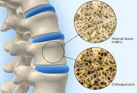 What Is Osteoporosis Treatment Symptoms Medication Increase Bone Density Osteoporosis Diet Healthy Bones
