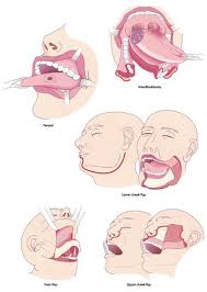 The body to another is this section has advice to help you talk with your child. Oral Cancer The State Of The Art Of Modern Day Diagnosis And Treatment Intechopen