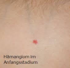 Kidsdoc Addoc Hamangiom Blutschwamm