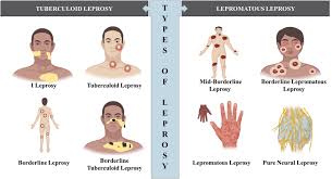 Image result for Leprosy