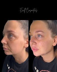 TEAR TROUGH FILLER 😍 Such an improvement (mild swelling).