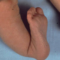 Diese fehlstellung tritt oft beidseitig auf und kann mit anderen fußfehlstellungen assoziiert sein. Kindliche Fussfehlstellungen Dr Medic Manuel Nastai Fusschirurgie