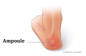 D'autres conseils à ajouter ? Comment Soigner Les Ampoules Et Les Ecorchures Ameliore Ta Sante Comment Soigner Soigner Une Ampoule Comment Soigner Une Ampoule