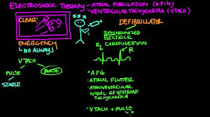 Image result for Synchronized Cardioversion