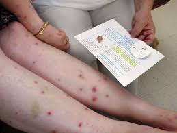 Punaise de lit tea tree. Eradiquer Les Punaises De Lit De Facon Naturelle C Est Possible