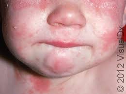 Image result for yellow scabs on the face in children