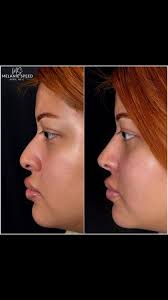 Flawless Non-Surgical Nose Job 👃🏼🪄, 👃🏼 Treatment ~ Nonsurgical nose  job ⠀⠀, 😘 Patient request ~ Straighten bridge and lift tip, 💉 Product  used ~ Restylane , ⏱Results ~ immediate⠀⠀⠀⠀⠀⠀⠀⠀⠀⠀⠀⠀, ⌛️ Lasts ...