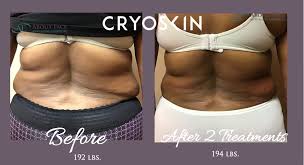 Liposuction, there are pluses and minuses to either. Cryoskin Cryotherapy For Slimming In Harker Heights Tx