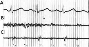 Image result for Venous Hum