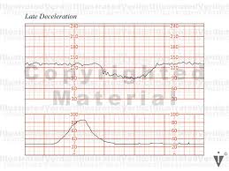 Image result for Late Deceleration