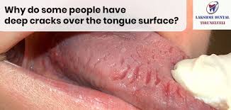 Image result for Fissured tongue