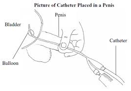 We did not find results for: Urinary Catheter Faqs What Is A Urinary Catheter Catheter Care Prostate Cancer Ucla