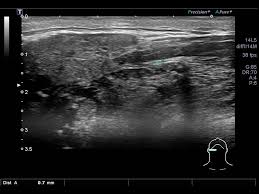 Image result for Submandibular Exam