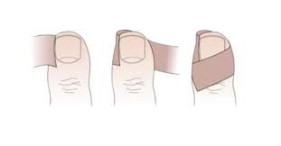 Image result for Akutní zánět nehtového lůžka