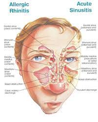 How To Get Rid Of Allergic Rhinitis Home Remedies Top 20 Remedies Home Remedies For Anything How To Acute Sinusitis Sinus Medicine Allergic Rhinitis