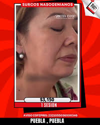 🌟 Surcos nasogenianos