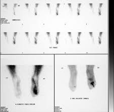 Image result for Osteomyelitis Bone Scan