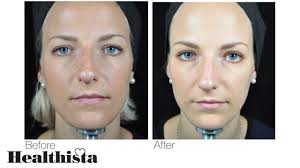 Check spelling or type a new query. The New Baby Botox This Is Exactly What Happens To Your Face Healthista