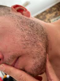 Image result for Beard Dermatitis
