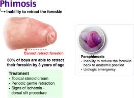 Image result for paraphimosis