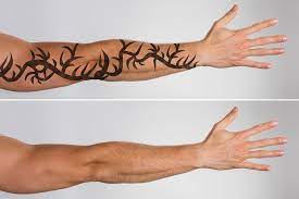 How much do tattoos cost? Laser Tattoo Removal How Long Does It Take To See Results