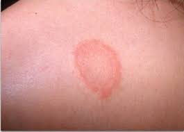 Dermatomikoz Strigushij Lishaj Tela