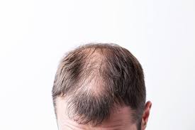 Wann macht eine haartransplantation sinn? Zu Welchem Zeitpunkt Ist Eine Haartransplantation Sinnvoll