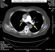 9 de febrero de 2009 a las 17:00 última respuesta: Sobre Tecnicas De Imagenes Medicas Blog Stim Tromboembolismo Pulmonar Tep Y Tc Multicorte 64 2Âº Capitulo