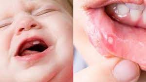 We did not find results for: 5 Cara Ampuh Menyembuhkan Sariawan Pada Anak Dengan Bahan Alami Yang Mudah Didapat Tanpa Ke Dokter Tribun Kaltim