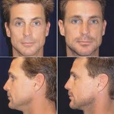 dr_ruder_Rhinoplasty6