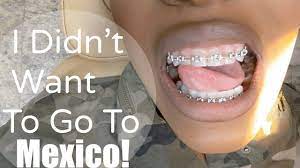 Sinuslift mexico cost $250 usd to $1,000 usd How Much To Remove Wisdom Teeth In Mexico Teethwalls