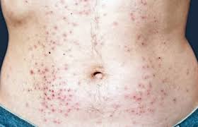 Image result for skin rash acute hiv infection