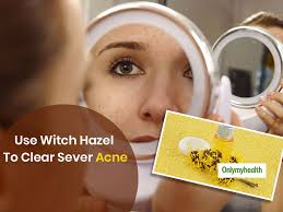 Maybe you would like to learn more about one of these? Home Remedies For Acne Use Witch Hazel For Pimple Free And Clear Face