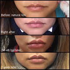 After lip injections how long does swelling last. A Little Lip N Tuck My Restylane Lip Filler Beautyandthecat S Beauty Blog